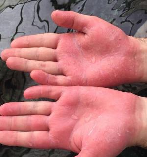一双手上长满了红疹
